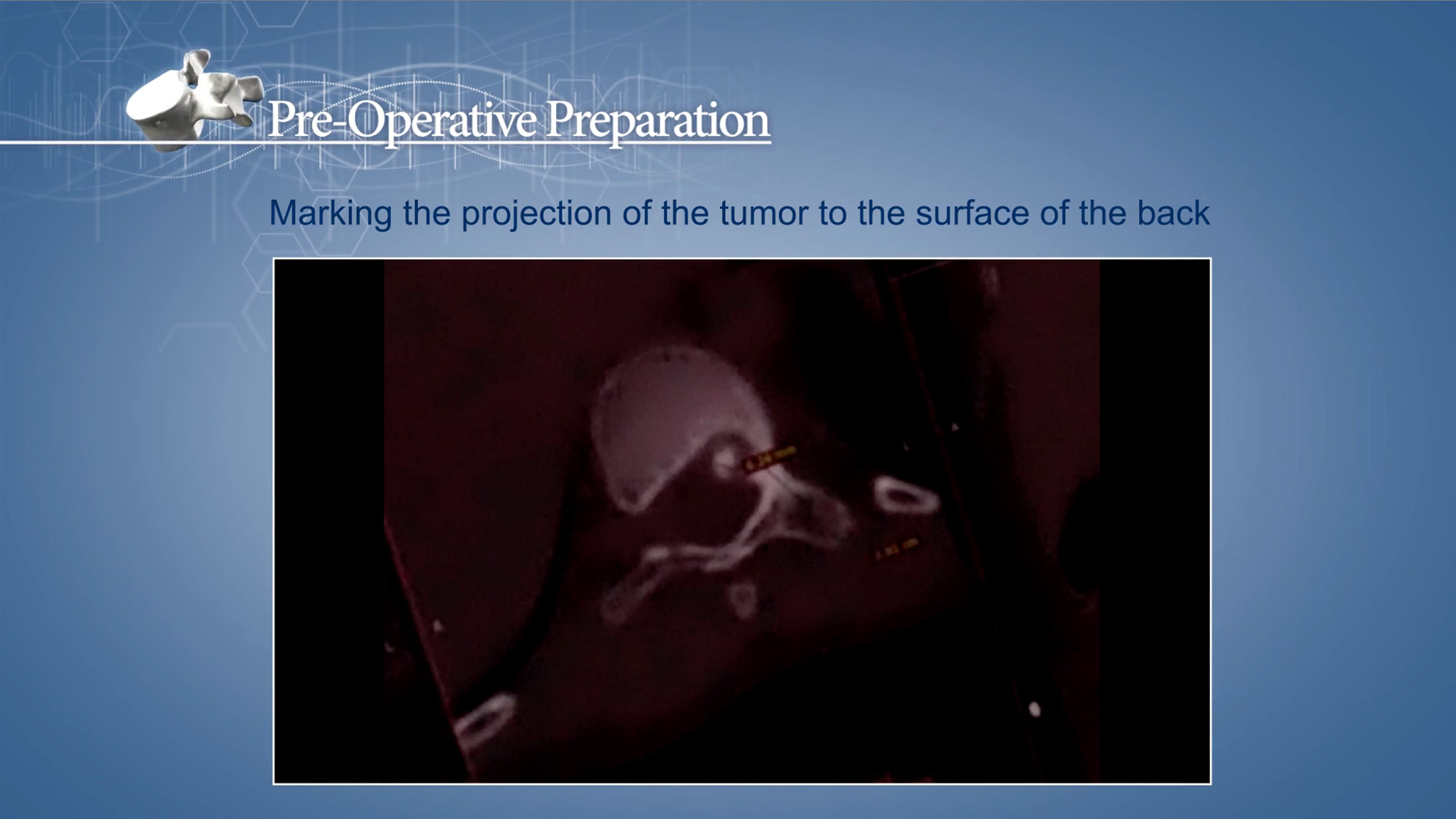 Osteoid Osteoma of Th 10 vertebra (Transition Pedicle - Vertebral Body L)